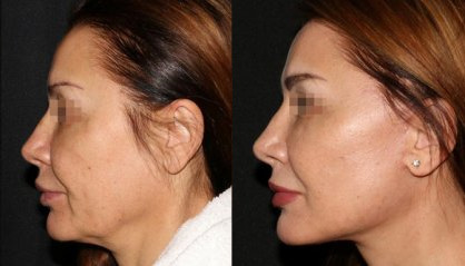 Antes e depois do lifting facial Lifting facial antes e depois