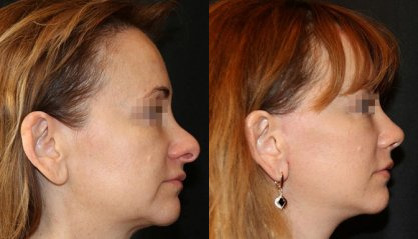 Antes e depois da rinoplastia Rinoplastia antes e depois
