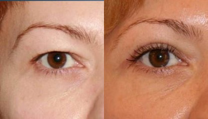 Antes e depois da blefaroplastia Blefaroplastia antes e depois