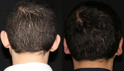 Antes e depois da otoplastia Otoplastia antes e depois