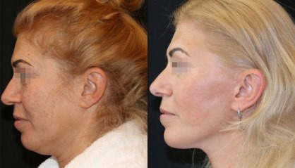 Antes e depois da mentoplastia Mentoplastia antes e depois