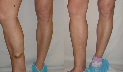 Antes e depois do procedimento