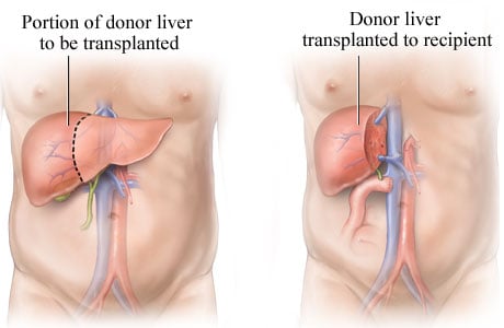 Processo de transplante de fígado