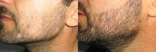 Transplante de barba