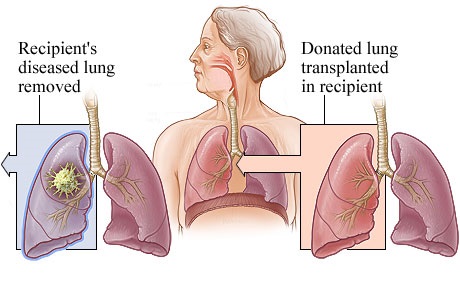 Esquema de transplante pulmonar