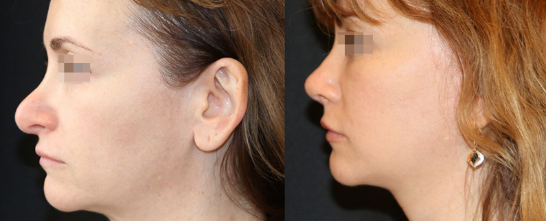 Paciente após rinoplastia