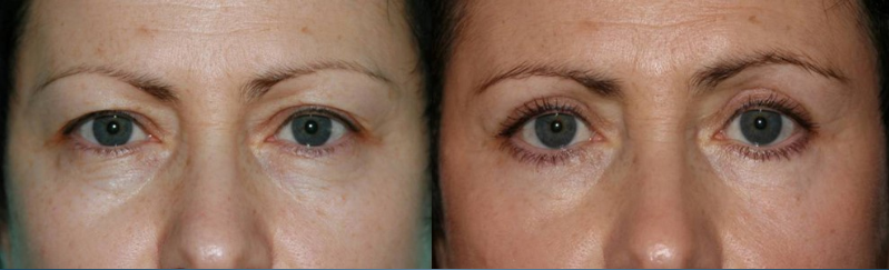 Paciente após blefaroplastia