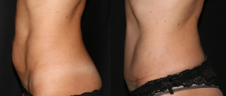 Paciente após lifting abdominal