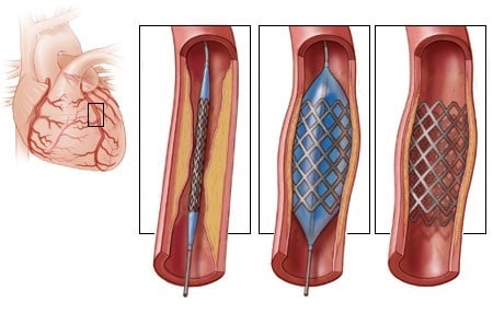Instalação de stent coronário