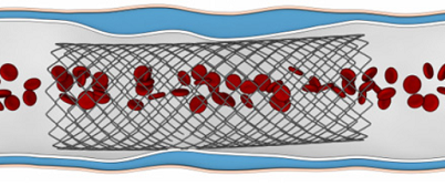 Esquema de colocação de stent